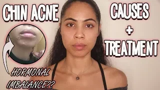 Chin Acne Why You re Getting It How To Prevent It Naturally