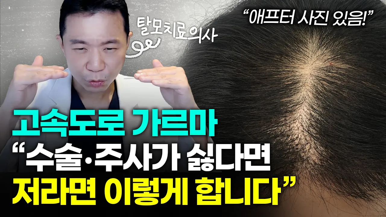 가르마 탈모, 이렇게도 할 수 있네요?