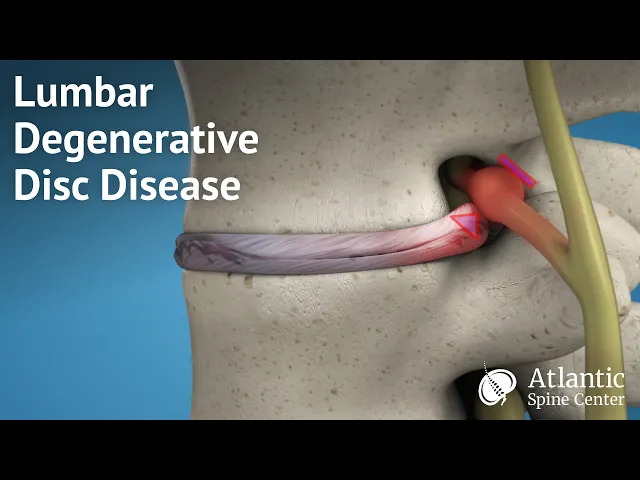 Lumbar Degenerative Disc Disease