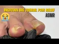 Lagu ingrown big toenail pain relief 😭 | pedicure cleaning | pedicure asmr