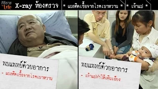 เท้าแปรที่เกิดจากภาวะแรกเกิดจะหายเองได้ไหม