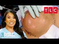Download Lagu All the Pops from Seasons 1-4! | Dr. Pimple Popper | TLC