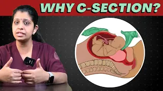 Doctor Said C-Section? Here Are 5 Reasons Why