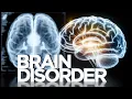 The Rare Brain Disorder That Changed RFK Jr s Voice Forever