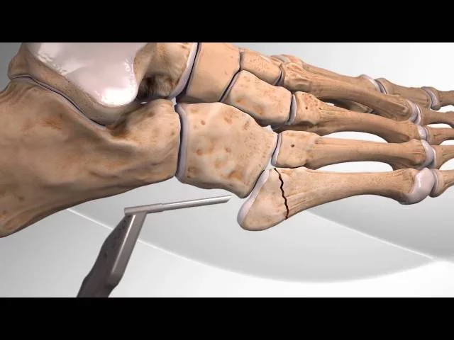 Metatarsal Fracture Repair with Arthrex® Jones Screw