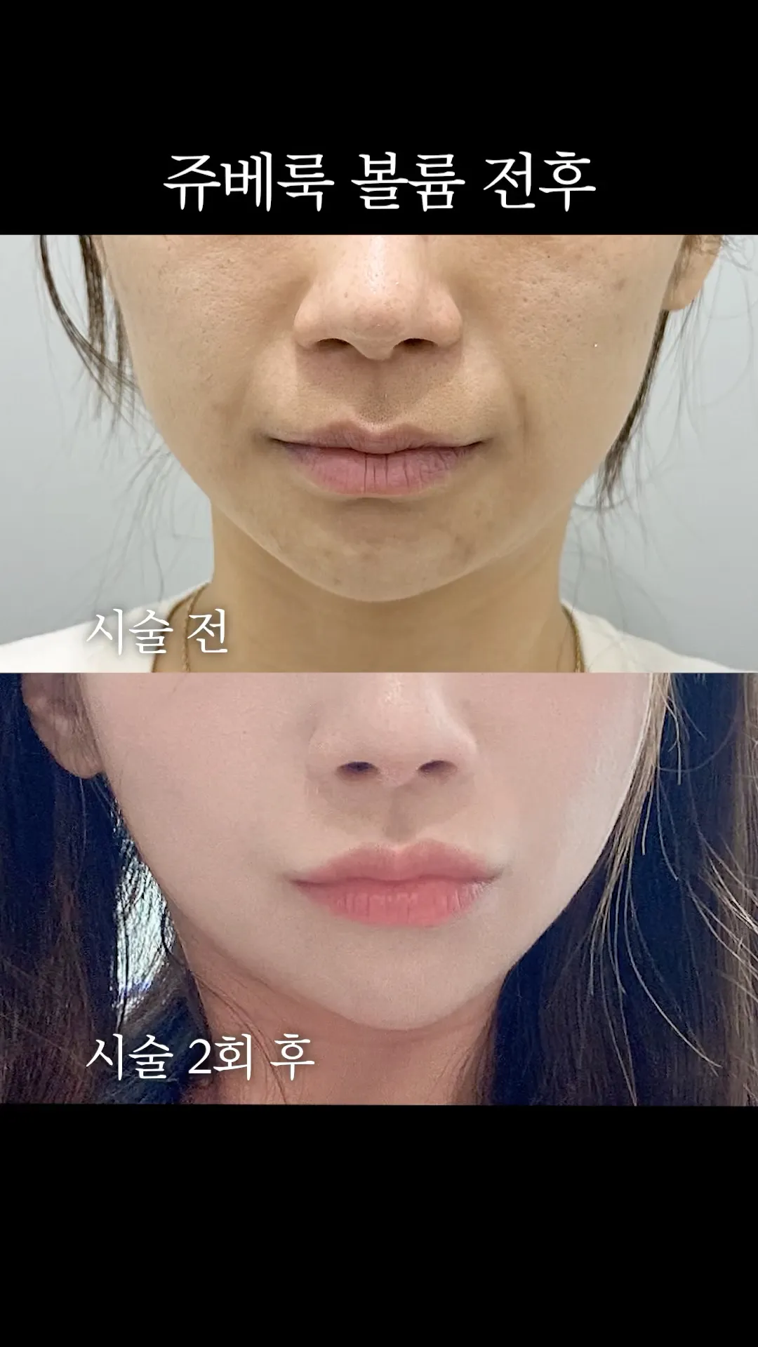 팔자주름 쫙 핀 쥬베룩 전후