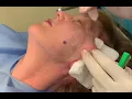 The Blackledge Face Lift Dr Adair Blackledge