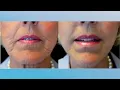 Upper Lip Wrinkles Gone in 30 days
