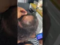 Alopecia Braids
