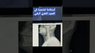 أستقامة تشنجية في العمود الفقري الرقبي 
