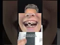 Things NOT to do when you first get Braces