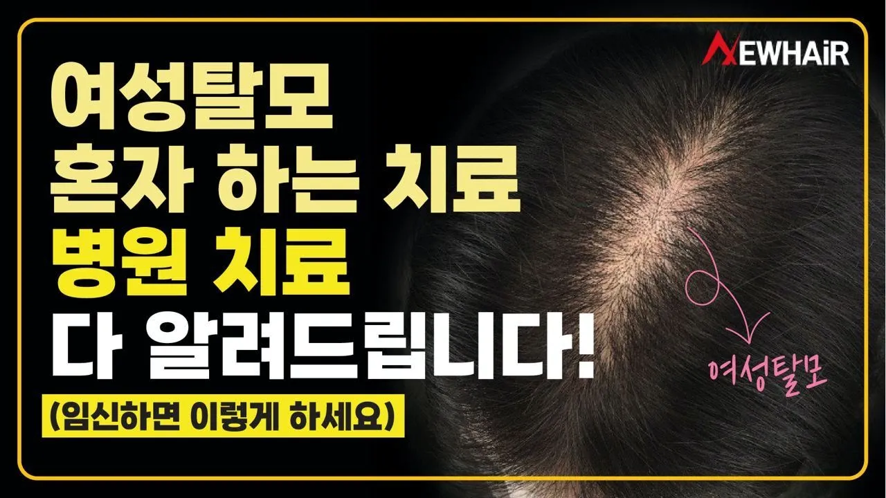 여성탈모, 혼자 하는 치료, 병원 치료는 이렇게 해야 합니다!