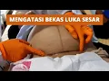 Lagu Scar Massage Pada POST Caesar (Pemijatan Bekas Luka Operasi Sesar)