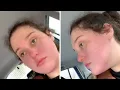 Woman Is Allergic to McDonald s