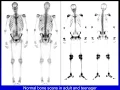 Essentials of Bone Scan - HD [Basic Radiology]