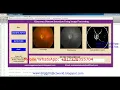 Glaucoma Detection Using Image Processing Matlab Project With Source Code Detect Glaucoma Matlab