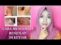 Download Lagu CARA MENGATASI BENJOLAN DI KETIAK SECARA ALAMI | OBAT HERBAL BENJOLAN