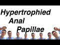 Hypertrophied Anal Papillae Irritation itching bleeding So Annoying