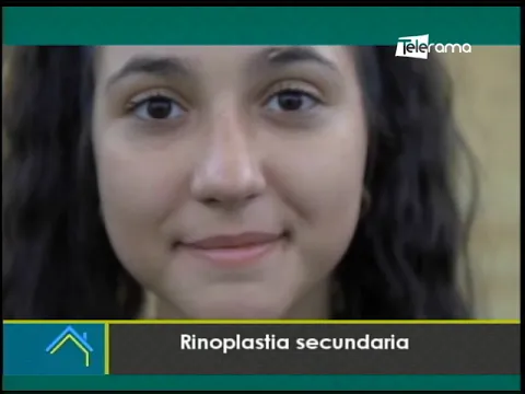 Rinoplastia secundaria