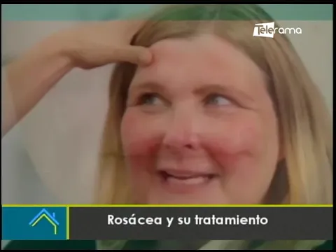 Rosácea y su tratamiento