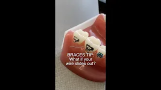 Braces Wire Poking Cheeks or Gums Here s What to Do