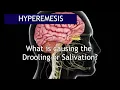 Lagu Hyperemesis: What causes the Excessive Salivation | Antai Hospital