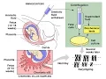 Amniocentesis vs Chorionic Villus Sampling