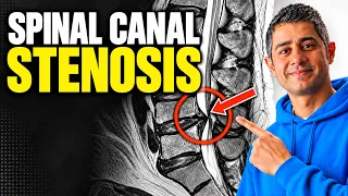 Spinal Canal Stenosis. Real patient story and best tips for management.