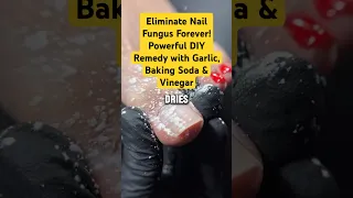 Eliminate Nail Fungus Forever Powerful DIY Remedy With Garlic Baking Soda Vinegar 