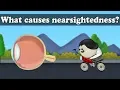 Myopia - What causes nearsightedness