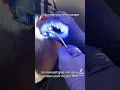 The triple crown of earwax removal