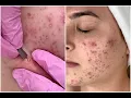 Acne Scars Blemish Brightening Clearing Facial Jadeywadey180