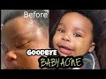HOW I CLEARED UP MY NEWBORNS ACNE FAST