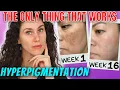 The ONLY Ingredients That Stop Hyperpigmentation And Reverse It