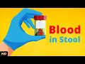 Download Lagu Blood In Stool – What Does It Mean?