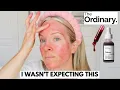 TRYING THE ORDINARY PEELING SOLUTION FOR THE FIRST TIME IN 6 YEARS DEMO SKINCARE ROUTINE