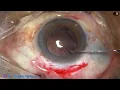 Download Lagu SICS for  ophthalmology residents and new surgeons : Pradip Mohanta, 25th January, 2022