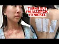 First time getting an allergy patch test results allergy eczema vlog