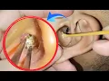 Download Lagu Horrifying Yet Satisfying Ear Wax Removal 😱 | Deep Ear Cleaning ASMR | EP 160