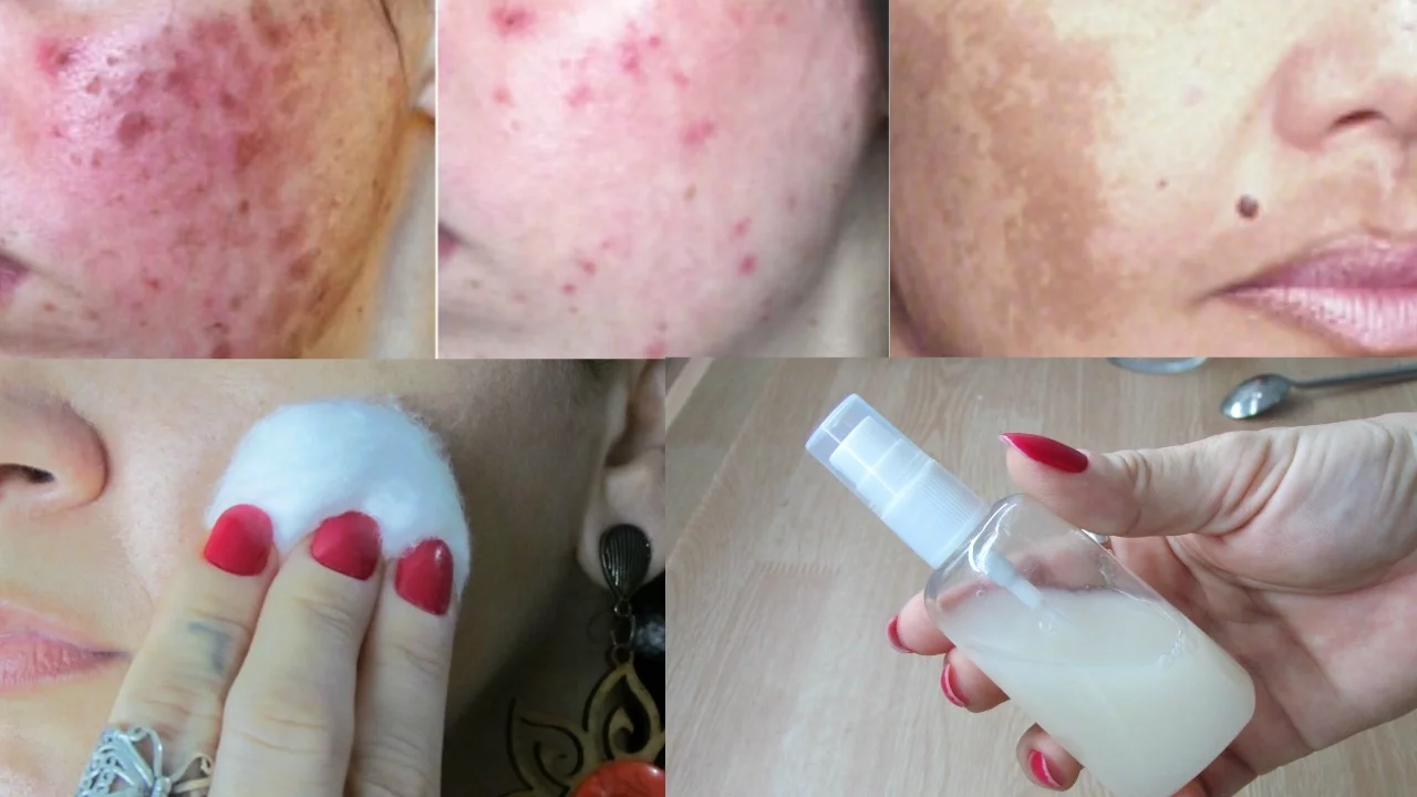 Use para CLAREAR qualquer MANCHA DE PELE ! Melasma , Manchas nas Axilas , Virilhas