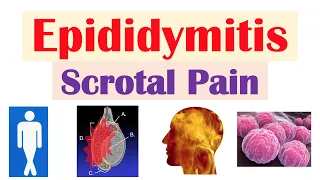 Epididymitis Scrotal Pain Causes Risk Factors Signs Symptoms Diagnosis Treatment
