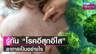 อาการของโรคหัวใจสลายมีลักษณะอย่างไร และสามารถตรวจพบได้อย่างไร