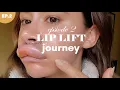 Download Lagu LIP LIFT SURGERY 💉 Episode 2 - When it goes very wrong...