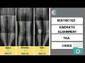 Restricted Kinematic Alignment TKA Cases examples