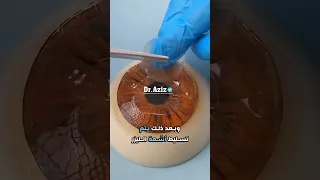 عملية تصحيح النظر 