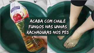 Esse Escalda Pés ACABA COM AS RACHADURAS CHULÉ E FUNGOS NAS UNHAS