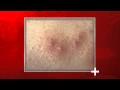 Bed Bug Bites Signs Health Impact National Pest Management Association