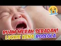 Lagu Hati-Hati Anak Demam dan Muncul Ruam Merah Bisa Jadi Kena Penyakit Roseola