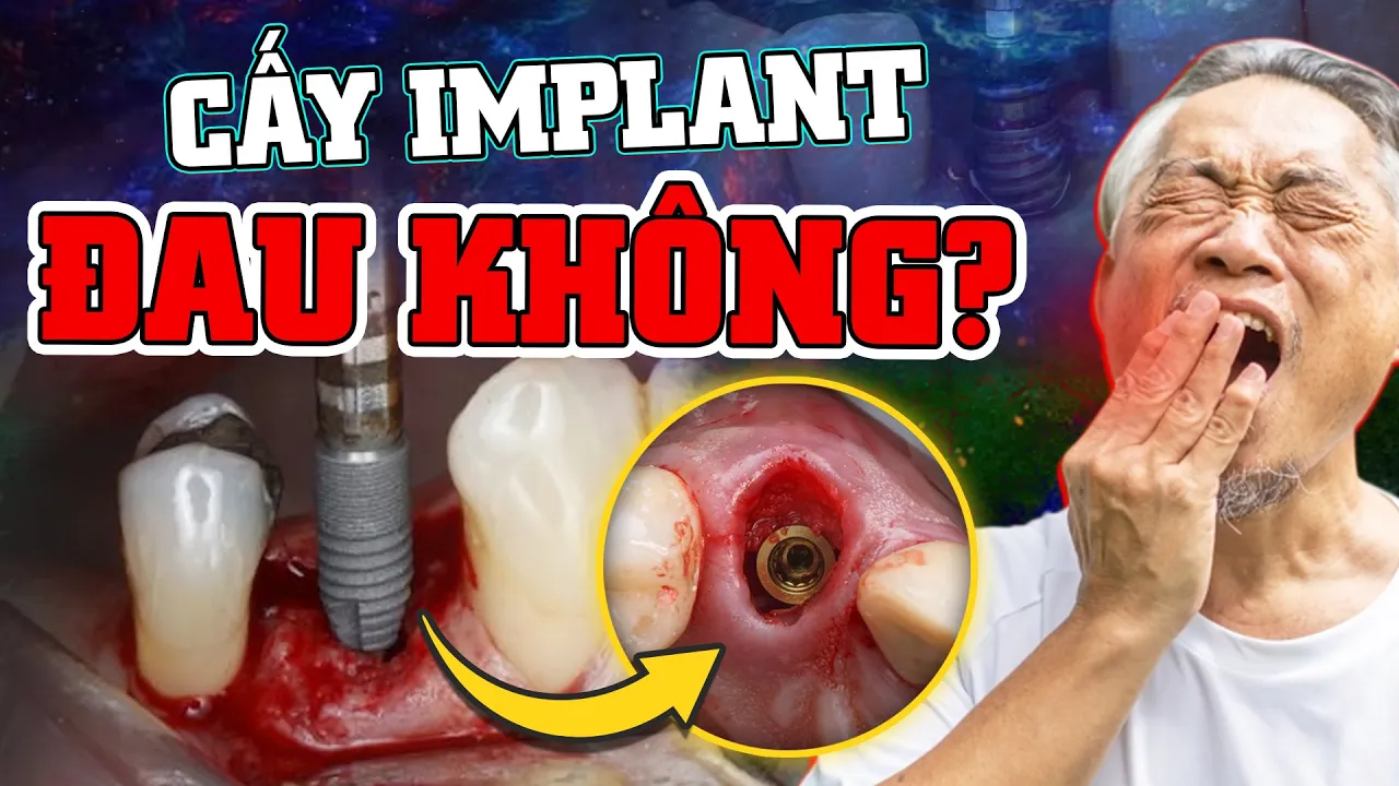 Outline Video Cấy Ghép Implant Có Đau Không? Hoàn Toàn Không Đau Nếu Áp Dụng Triệt Để Những Cách Này!