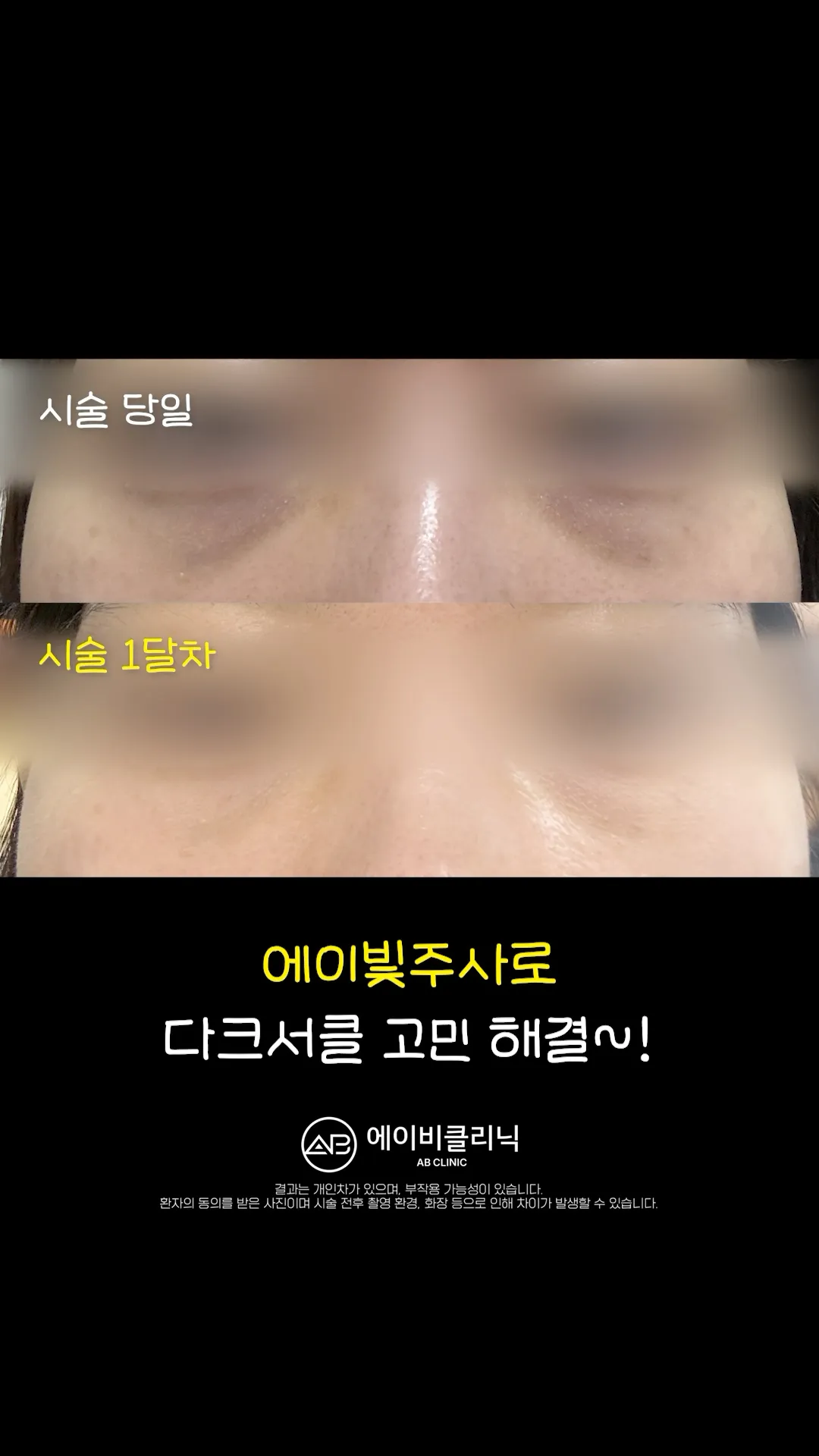 컨실러 없이 다크써클 지우는 법